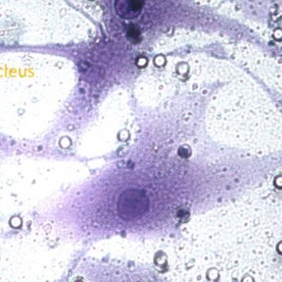 A snapshot of Emma's research: rheumatoid arthritis synovial fibroblasts that have invaded through an experimental chamber.